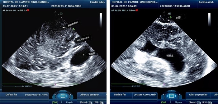左圖顯示術(shù)中超聲見囊實性病變，大小約為4x4x3cm，病灶周圍腦組織水腫明顯；右圖為病灶切除后，術(shù)中超聲示術(shù)腔無病變殘留